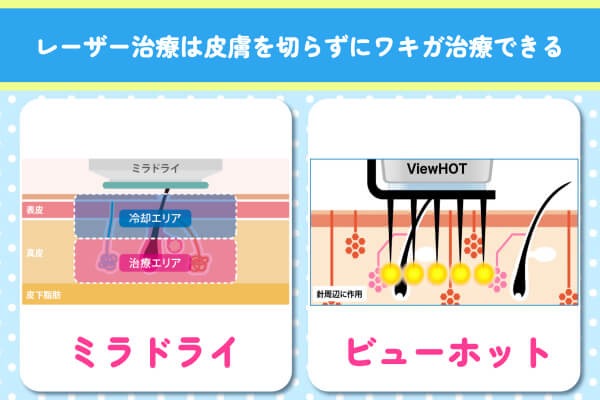 レーザー治療はワキを切らずに治療ができる